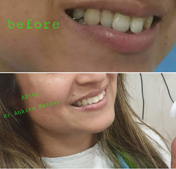 Best Dentist for Dentures in Kandivali