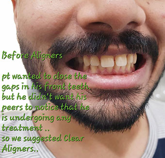 Best Dentist for Dentures in Kandivali