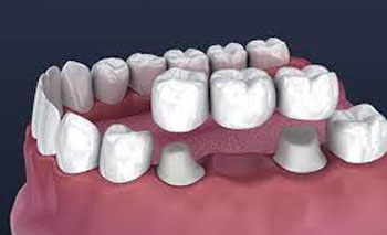 Root Canal Treatment in Kandivali