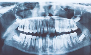 Root Canal Treatment in Kandivali